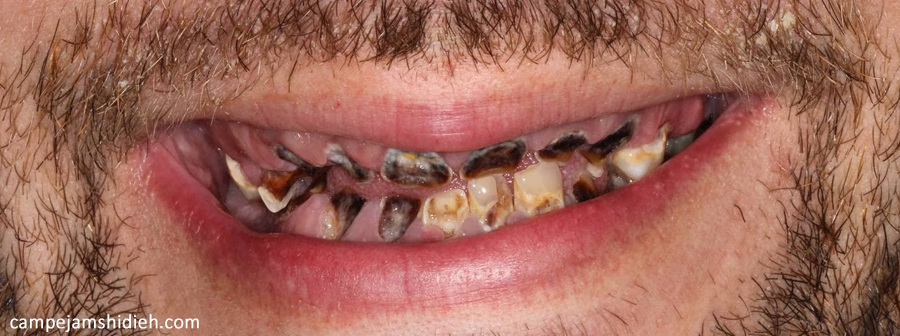 تأثیر مصرف مواد مخدر بر سلامت دندان